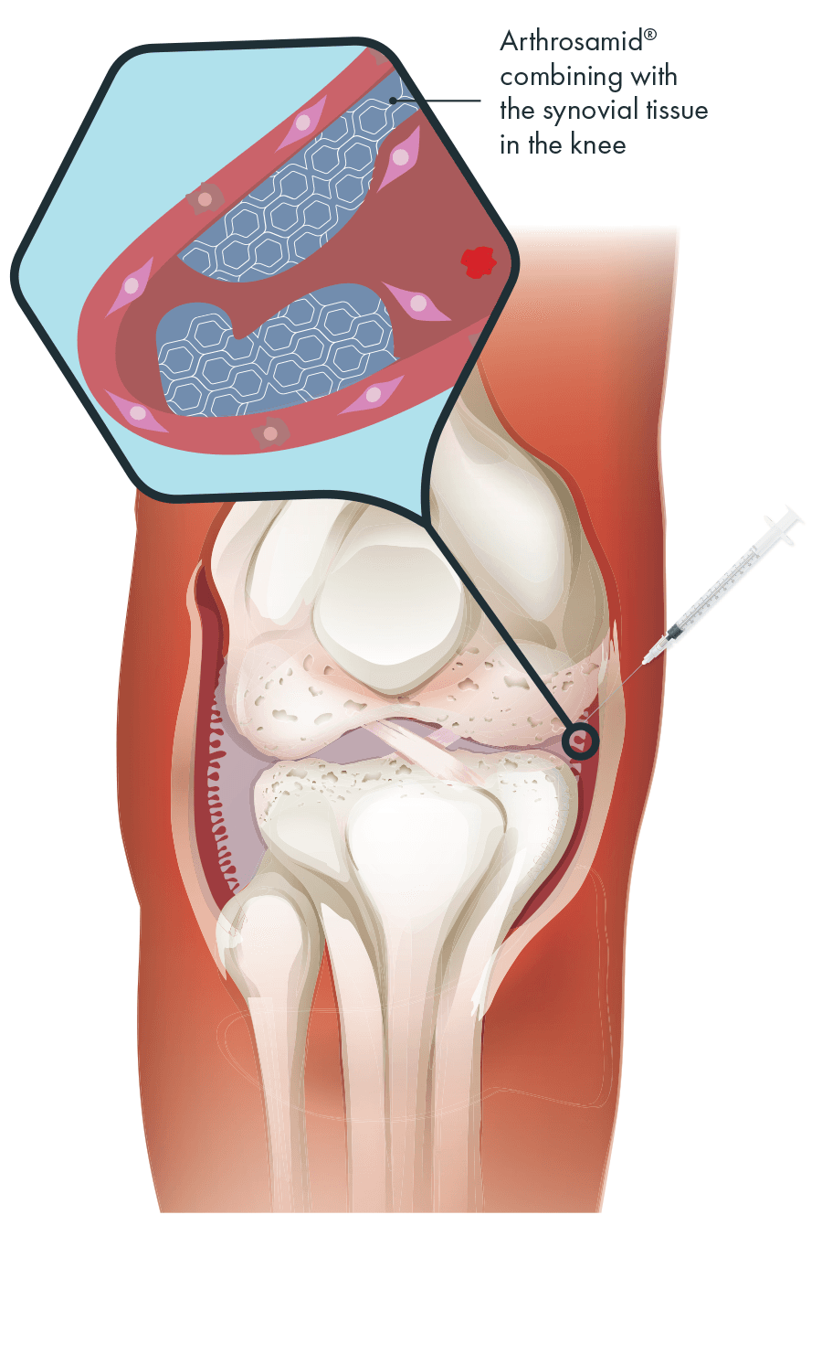 Knee Osteoarthritis